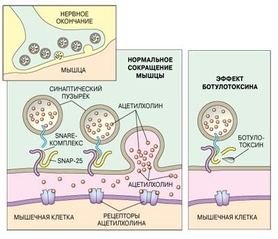 Liệu pháp Botulinum trong thẩm mỹ - nó là gì, hiệu quả và kết quả, đánh giá. Dysport, Xeomin, Botox