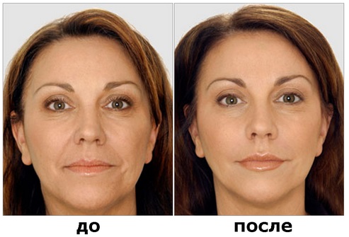 Liệu pháp Botulinum trong thẩm mỹ - nó là gì, hiệu quả và kết quả, đánh giá. Dysport, Xeomin, Botox