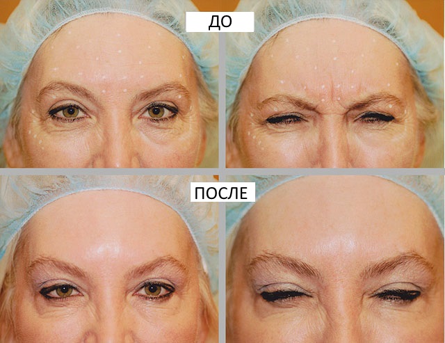 Liệu pháp Botulinum trong thẩm mỹ - nó là gì, hiệu quả và kết quả, đánh giá. Dysport, Xeomin, Botox