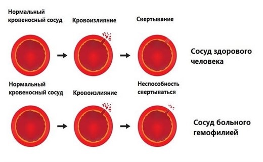 Liệu pháp Botulinum trong thẩm mỹ - nó là gì, hiệu quả và kết quả, đánh giá. Dysport, Xeomin, Botox