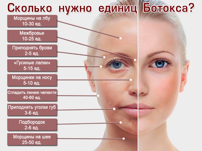 Liệu pháp Botulinum trong thẩm mỹ - nó là gì, hiệu quả và kết quả, đánh giá. Dysport, Xeomin, Botox