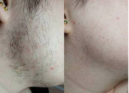 Darsonvalization - nó là gì trong thẩm mỹ, lợi ích của quy trình đối với da mặt, đầu, mí mắt, tóc, thiết bị. Chỉ định và chống chỉ định, hiệu quả