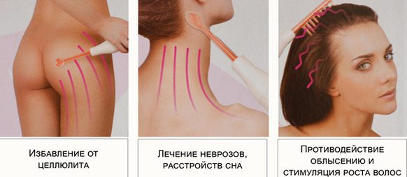 Darsonvalization - nó là gì trong thẩm mỹ, lợi ích của quy trình đối với da mặt, đầu, mí mắt, tóc, thiết bị. Chỉ định và chống chỉ định, hiệu quả