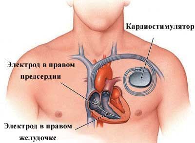 Darsonvalization - nó là gì trong thẩm mỹ, lợi ích của quy trình đối với da mặt, đầu, mí mắt, tóc, thiết bị. Chỉ định và chống chỉ định, hiệu quả