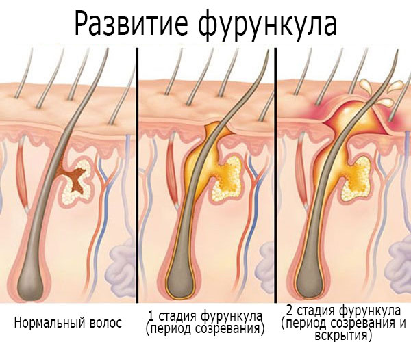 Darsonvalization - nó là gì trong thẩm mỹ, lợi ích của quy trình đối với da mặt, đầu, mí mắt, tóc, thiết bị. Chỉ định và chống chỉ định, hiệu quả