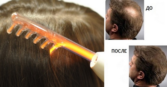 Darsonvalization - nó là gì trong thẩm mỹ, lợi ích của quy trình đối với da mặt, đầu, mí mắt, tóc, thiết bị. Chỉ định và chống chỉ định, hiệu quả