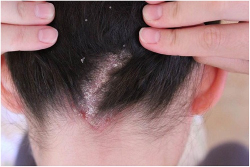Tinh dầu tràm trà, đặc tính. Ứng dụng cho tóc, răng, mặt. Với tưa miệng, nấm móng tay, mụn trứng cá, mụn cóc, u nhú, bên trong