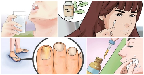 Tinh dầu tràm trà, đặc tính. Ứng dụng cho tóc, răng, mặt. Với tưa miệng, nấm móng tay, mụn trứng cá, mụn cóc, u nhú, bên trong