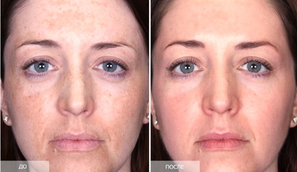 Enzyme lột: nó là gì, lợi ích cho da mặt: salicylic, có tính axit. Cách chọn những đánh giá tốt nhất