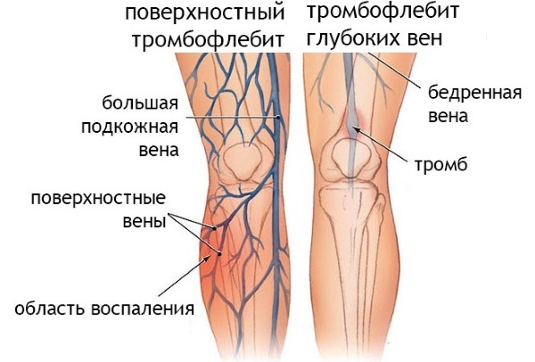 Хепаринска маст. Упутства за употребу, састав, индикације и контраиндикације за употребу, аналоги
