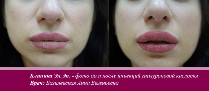 Axit hyaluronic cho môi: ảnh trước và sau, ưu nhược điểm, tác dụng, chống chỉ định. Giá thủ tục và đánh giá