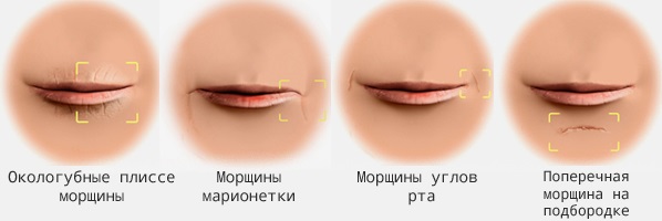 Axit hyaluronic cho môi: ảnh trước và sau, ưu nhược điểm, tác dụng, chống chỉ định. Giá thủ tục và đánh giá