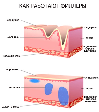 Ảnh chụp đôi môi trước và sau khi nâng mũi bằng axit hyaluronic. Hiệu quả kéo dài bao lâu khi chứng phù nề biến mất