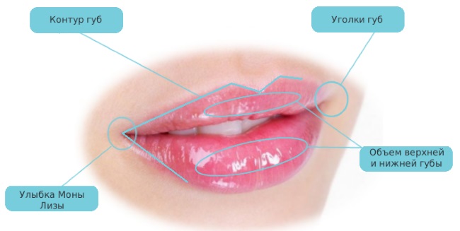 Ảnh chụp đôi môi trước và sau khi nâng mũi bằng axit hyaluronic. Hiệu quả kéo dài bao lâu khi chứng phù nề biến mất
