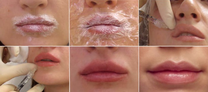Ảnh chụp đôi môi trước và sau khi nâng mũi bằng axit hyaluronic. Hiệu quả kéo dài bao lâu khi chứng phù nề biến mất