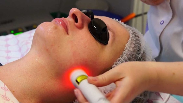 Ảnh chụp đôi môi trước và sau khi nâng mũi bằng axit hyaluronic. Hiệu quả kéo dài bao lâu khi chứng phù nề biến mất
