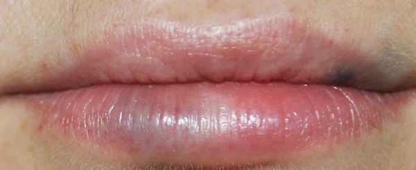 Ảnh chụp đôi môi trước và sau khi nâng mũi bằng axit hyaluronic. Hiệu quả kéo dài bao lâu khi chứng phù nề biến mất