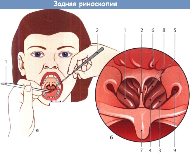 Độ cong của vách ngăn mũi. Điều trị không phẫu thuật bằng các biện pháp dân gian, bảo tồn, laser