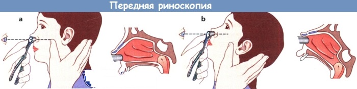Độ cong của vách ngăn mũi. Điều trị không phẫu thuật bằng các biện pháp dân gian, bảo tồn, laser
