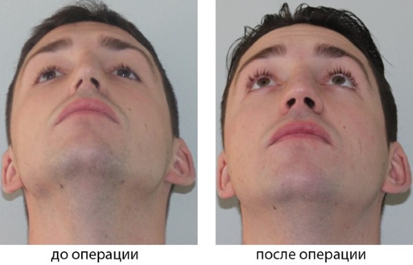 Закривљеност носног септума. Симптоми, узроци и последице. Операција септопластике: индикације, контраиндикације, врсте и карактеристике