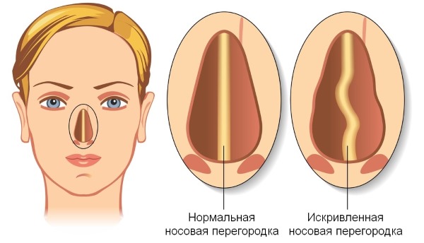 Закривљеност носног септума. Симптоми, узроци и последице. Операција септопластике: индикације, контраиндикације, врсте и карактеристике