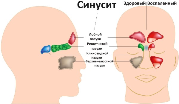 Закривљеност носног септума. Симптоми, узроци и последице. Операција септопластике: индикације, контраиндикације, врсте и карактеристике