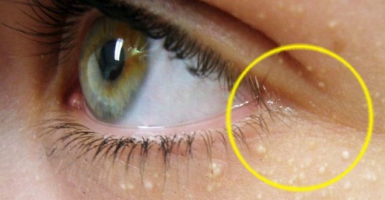 Miliums trên mặt. Ảnh, cách xóa, điều trị tại nhà, xóa bằng laser dưới mắt, trên mí mắt, cằm, toàn thân. Nguyên nhân ở người lớn và trẻ em