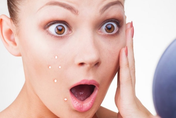 Miliums trên mặt. Ảnh, cách xóa, điều trị tại nhà, xóa bằng laser dưới mắt, trên mí mắt, cằm, toàn thân. Nguyên nhân ở người lớn và trẻ em