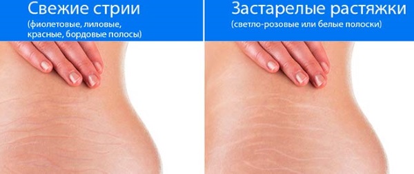 Како се отарасити стрија, уклонити на грудима, стомаку, задњици, телу, ногама, куковима након порођаја, током трудноће.Креме, уље, мумија, ласерско уклањање