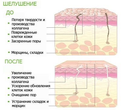 Како се отарасити стрија, уклонити на грудима, стомаку, задњици, телу, ногама, куковима након порођаја, током трудноће. Креме, уље, мумија, ласерско уклањање