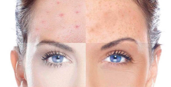 Cara menentukan jenis kulit wajah: berminyak, kering, kombinasi, normal.Ciri-ciri menentukan jenis foto, subtone, jenis warna Fitzpatrick