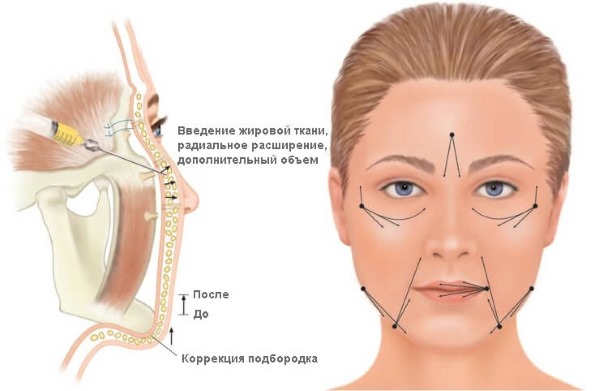Cara menghilangkan lipatan nasolabial: pengisi, asid hyaluronik, pembetulan kontur, botox dan lipofilling, latihan wajah