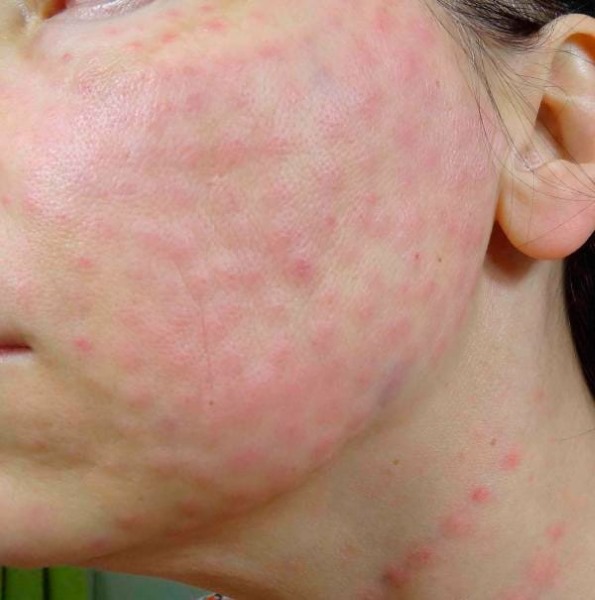 Cara menghilangkan lipatan nasolabial: pengisi, asid hyaluronik, pembetulan kontur, botox dan lipofilling, latihan wajah
