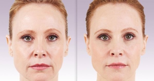 Cara menghilangkan lipatan nasolabial: pengisi, asid hyaluronik, pembetulan kontur, botox dan lipofilling, latihan wajah