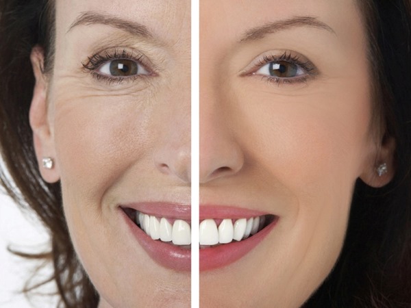 Cara menghilangkan lipatan nasolabial: pengisi, asid hyaluronik, pembetulan kontur, botox dan lipofilling, latihan wajah