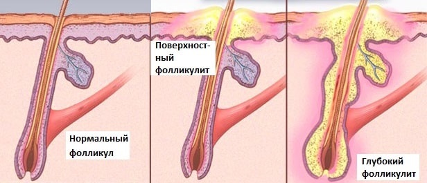 Triệt lông bằng laser trên mặt, vùng bikini, chân vĩnh viễn. Giá, thiết bị để tháo lắp tại nhà. Một bức ảnh