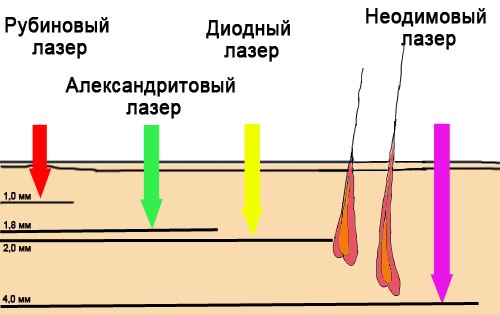 Triệt lông bằng laser trên mặt, vùng bikini, chân vĩnh viễn. Giá, thiết bị để tháo lắp tại nhà. Một bức ảnh