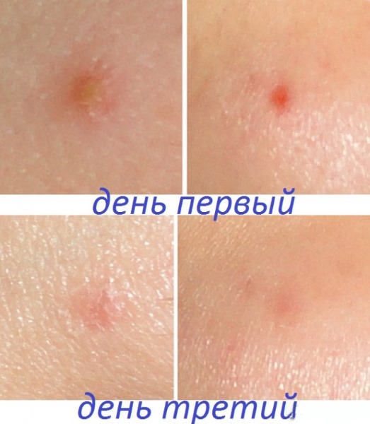 Како користити Левомекол за акне на лицу. Упутства, индикације и контраиндикације