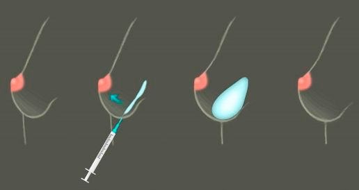 Senos pequeños. Mamoplastia para aumento de senos: cómo va, cuánto cuesta, rehabilitación, indicaciones y contraindicaciones