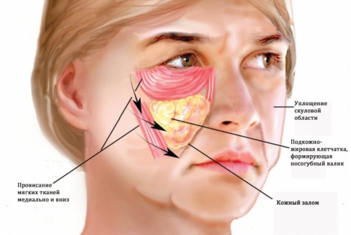 Làm thế nào để loại bỏ túi sơn trên gò má mà không cần phẫu thuật, phương pháp dân gian, tiêu mỡ trong thẩm mỹ