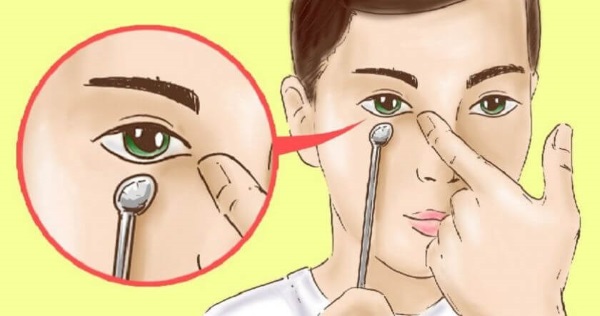 Làm thế nào để loại bỏ túi sơn trên gò má mà không cần phẫu thuật, phương pháp dân gian, tiêu mỡ trong thẩm mỹ