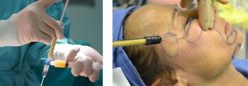 Làm thế nào để loại bỏ túi sơn trên gò má mà không cần phẫu thuật, phương pháp dân gian, tiêu mỡ trong thẩm mỹ