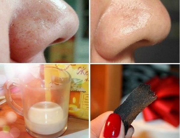 Topeng blackhead buatan sendiri adalah yang paling berkesan, dengan arang aktif, gelatin, soda, filem, pembersihan