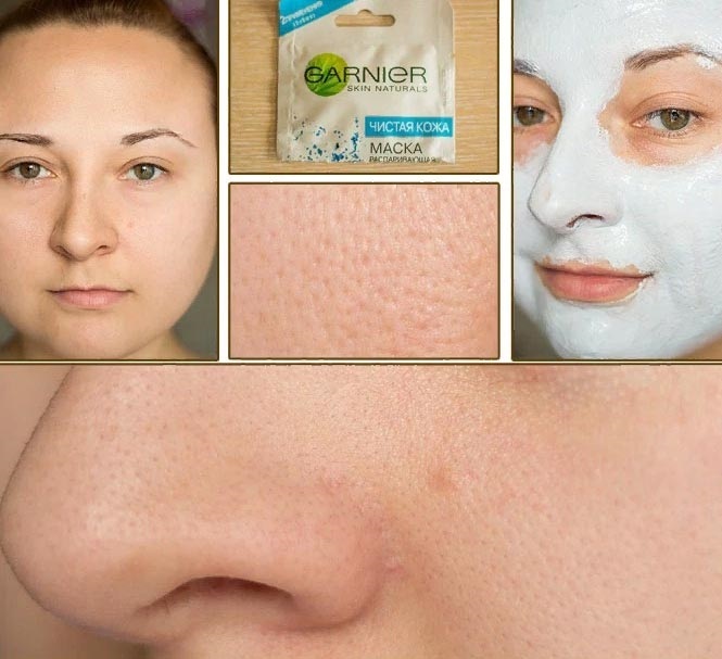 Topeng blackhead buatan sendiri adalah yang paling berkesan, dengan arang aktif, gelatin, soda, filem, pembersihan