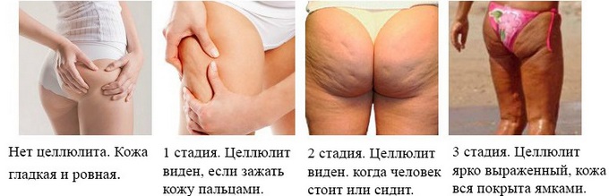 Обмотајте целулит кремом Цапсицам на бутинама, задњици, стомаку. Ефективни домаћи рецепти