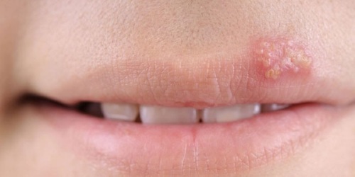 جل بانافير للأورام الحليمية. تعليمات الاستخدام ، نظائرها ، السعر ، المراجعات