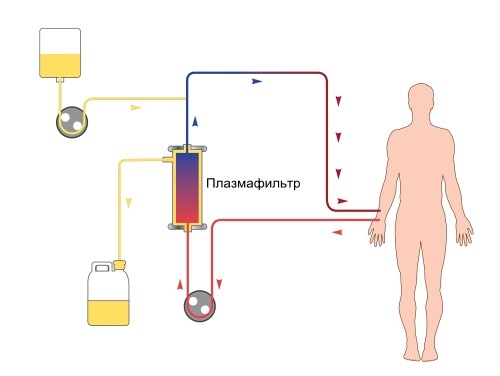 Plasmaphoresis - chỉ định sử dụng trong phụ khoa, mang thai, dị ứng, bệnh vẩy nến. Các tác dụng phụ có thể xảy ra, chi phí của thủ thuật