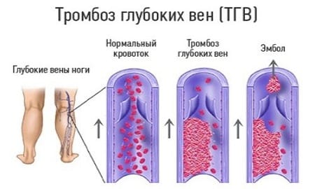 Plasmaphoresis - chỉ định sử dụng trong phụ khoa, mang thai, dị ứng, bệnh vẩy nến. Các tác dụng phụ có thể xảy ra, chi phí của thủ thuật