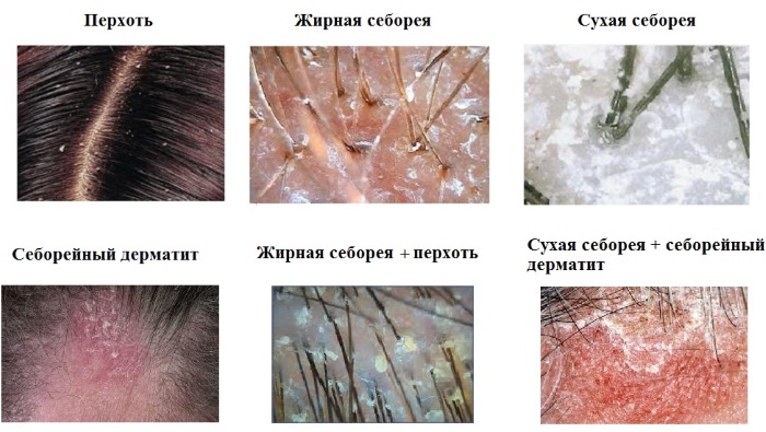 Axit salicylic cho mụn trứng cá. Sử dụng như thế nào để không gây bỏng, có tác dụng gì trong viên uống, đơn thuốc có diệp hạ châu. Chỉ định và chống chỉ định