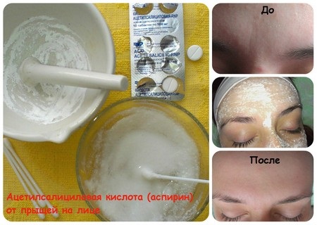 Axit salicylic cho mụn trứng cá. Sử dụng như thế nào để không gây bỏng, có tác dụng gì trong viên uống, đơn thuốc có diệp hạ châu. Chỉ định và chống chỉ định